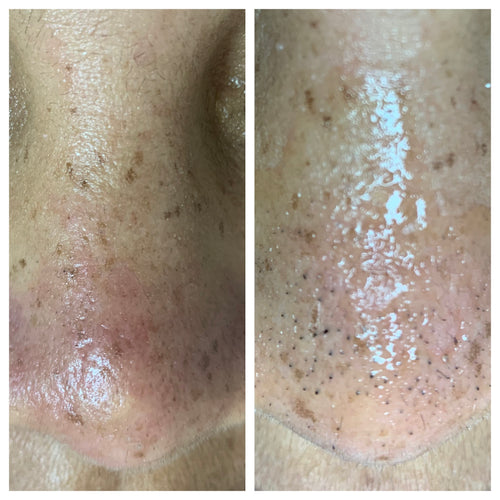 60 Minute Microdermabrasion facial